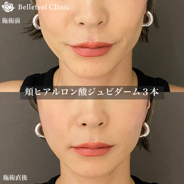 頬のたるみ・頬のコケのヒアルロン酸注入の症例写真