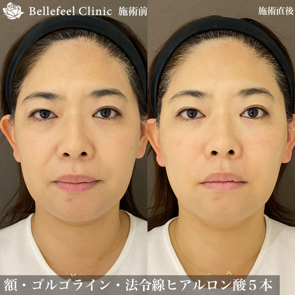 ゴルゴラインのヒアルロン酸注入の症例写真