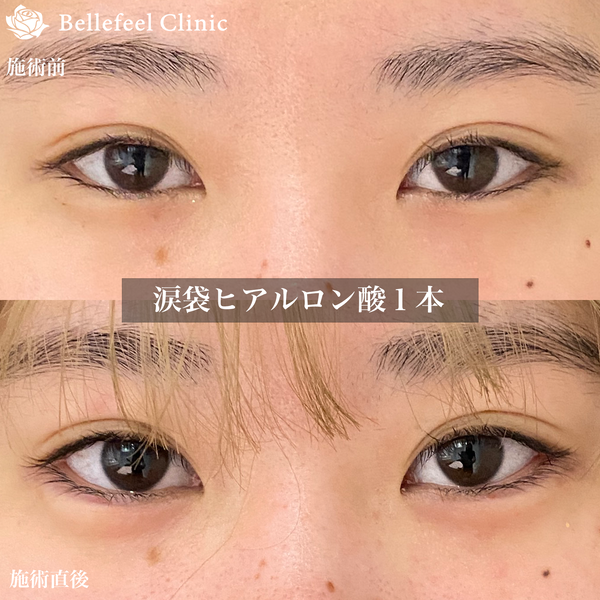 涙袋のヒアルロン酸注入の症例写真