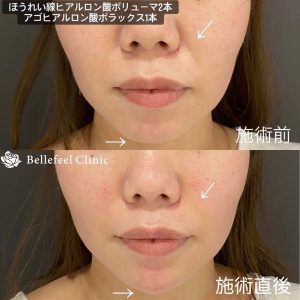 【ほうれい線】ヒアルロン酸注入 計3本