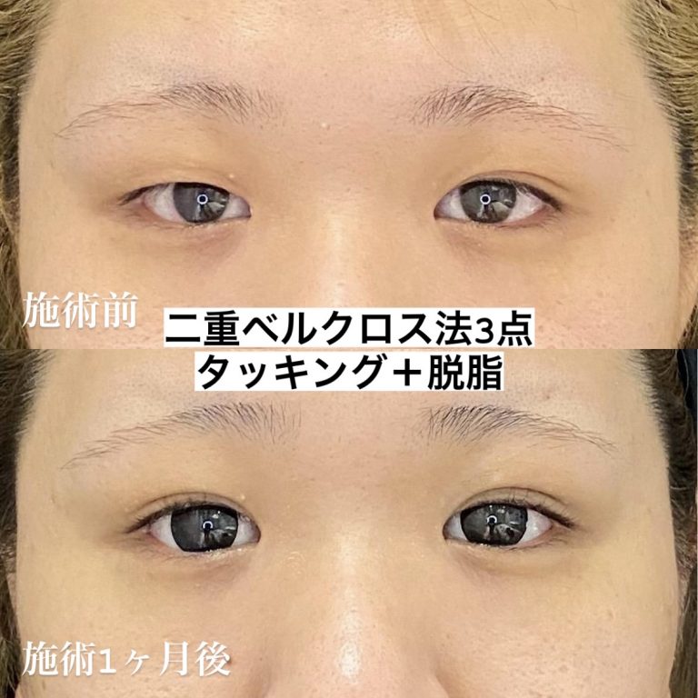 【二重埋没ベルクロス法】３点留め+タッキング+脱脂（1か月後）