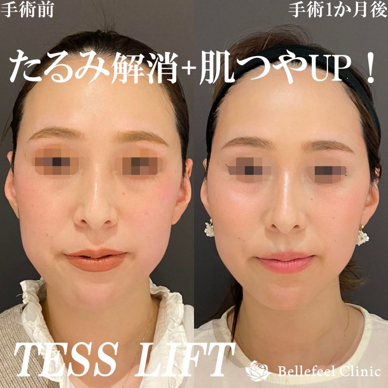 【糸リフト】テスリフト 8本